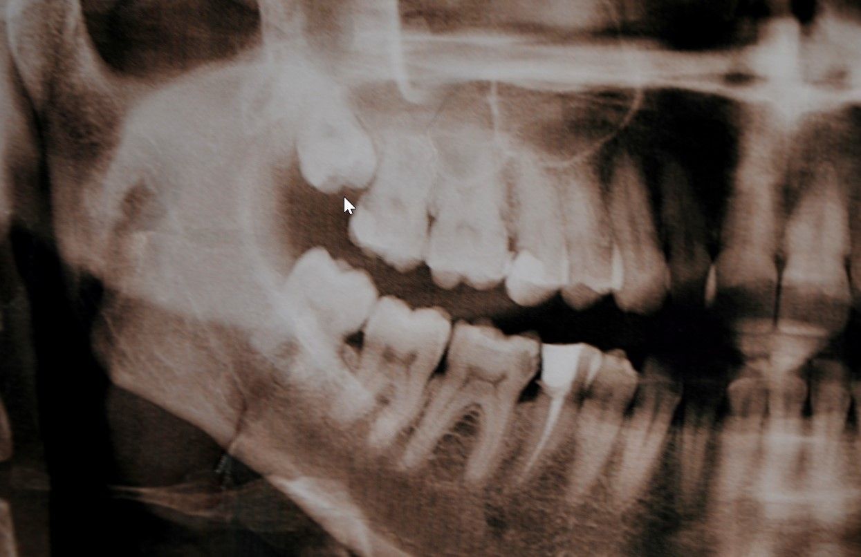 Удаление дистопированного зуба    