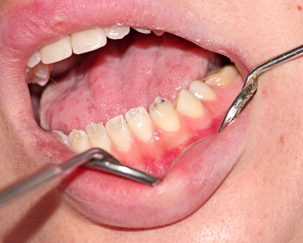Некариозные поражения зубов: виды, причины, лечение и профилактика.  