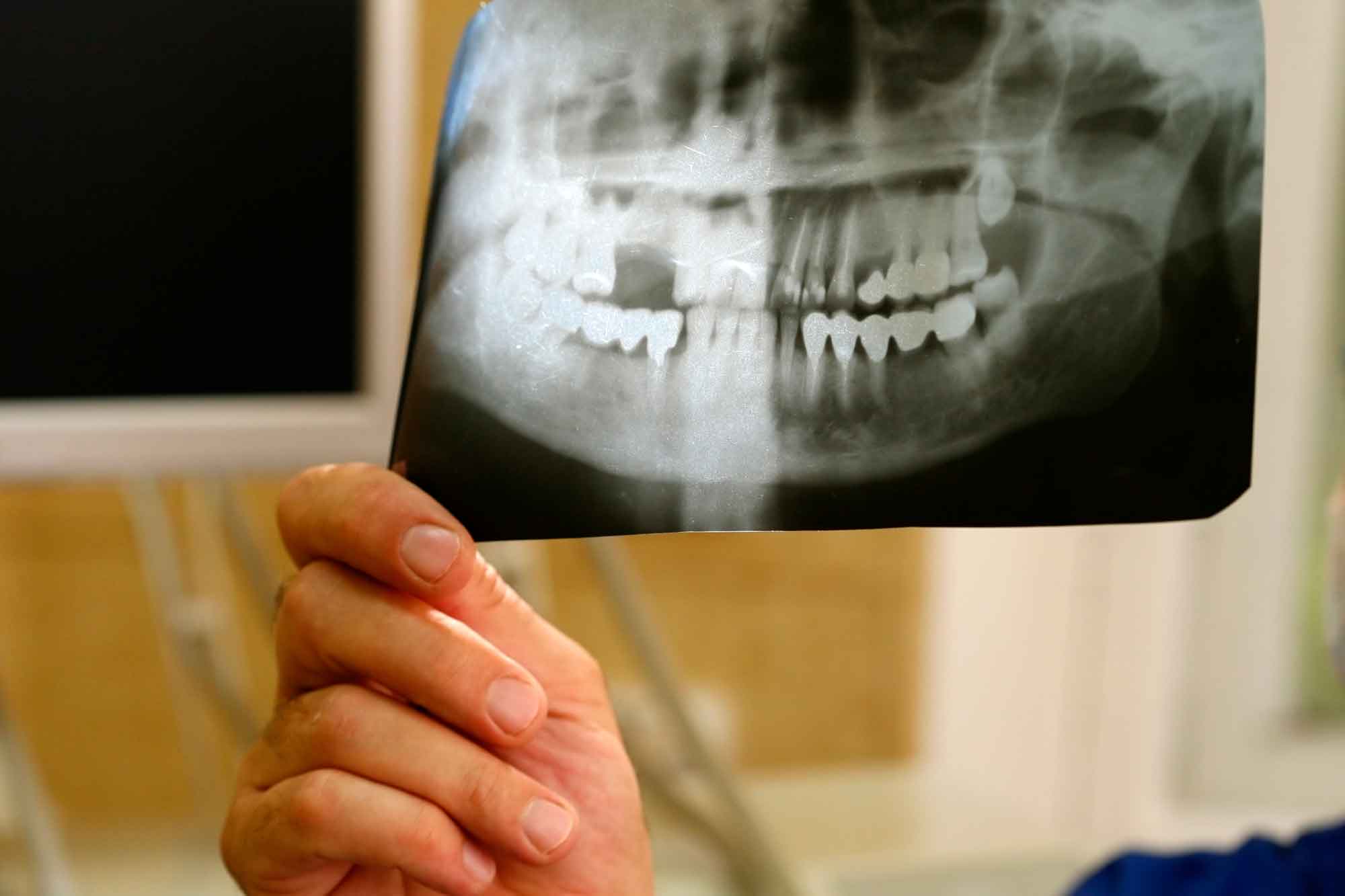 Бюджетная имплантация зубов 3