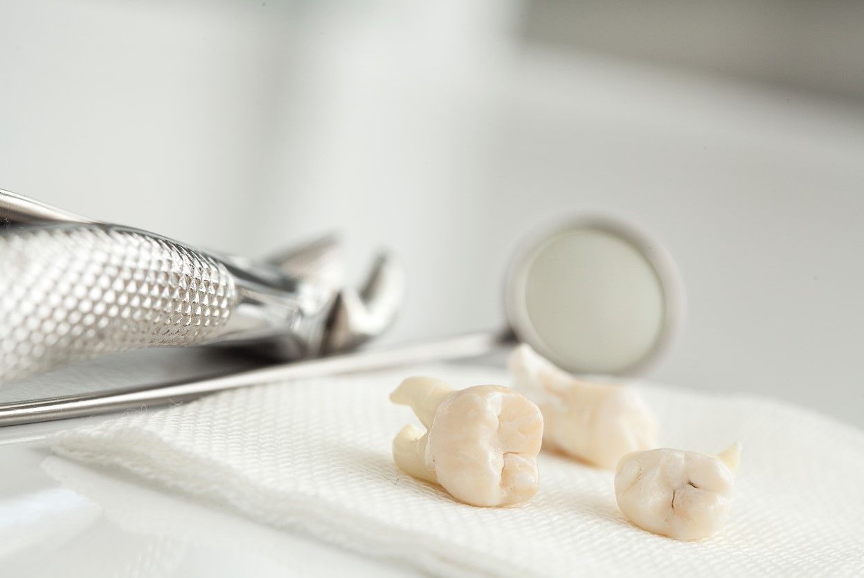 Что такое реплантация зуба: особенности проведения операции