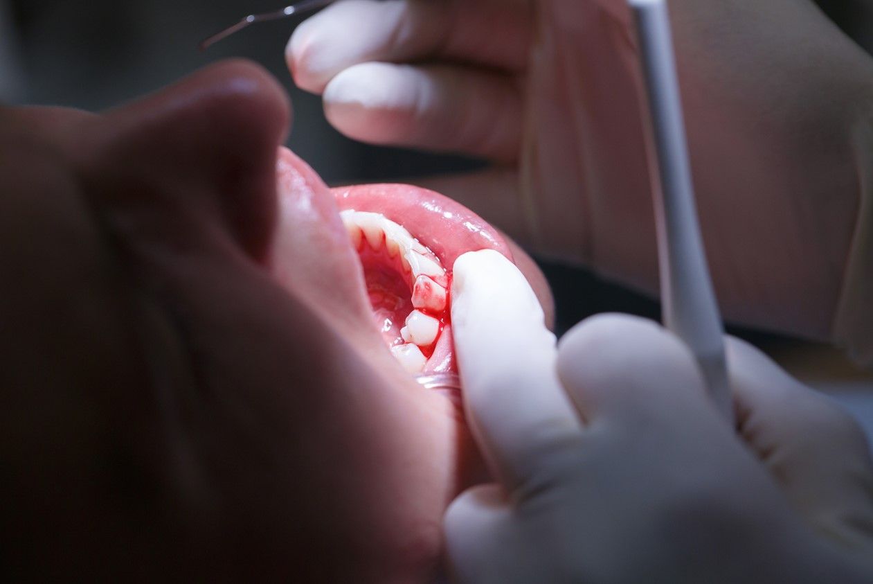 Лечение подвижных зубов у взрослых 