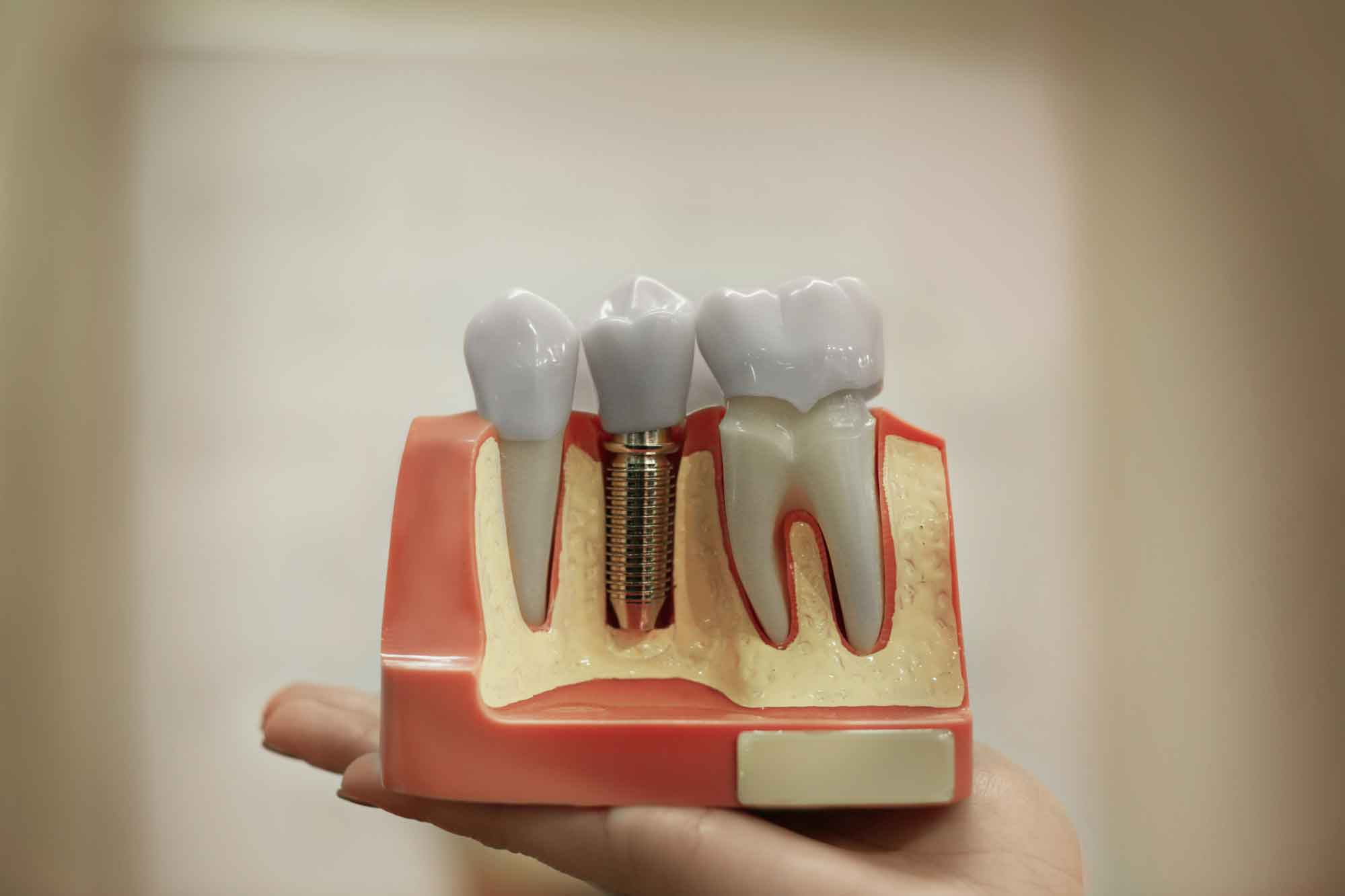Больно ли делать имплантацию зубов? 2