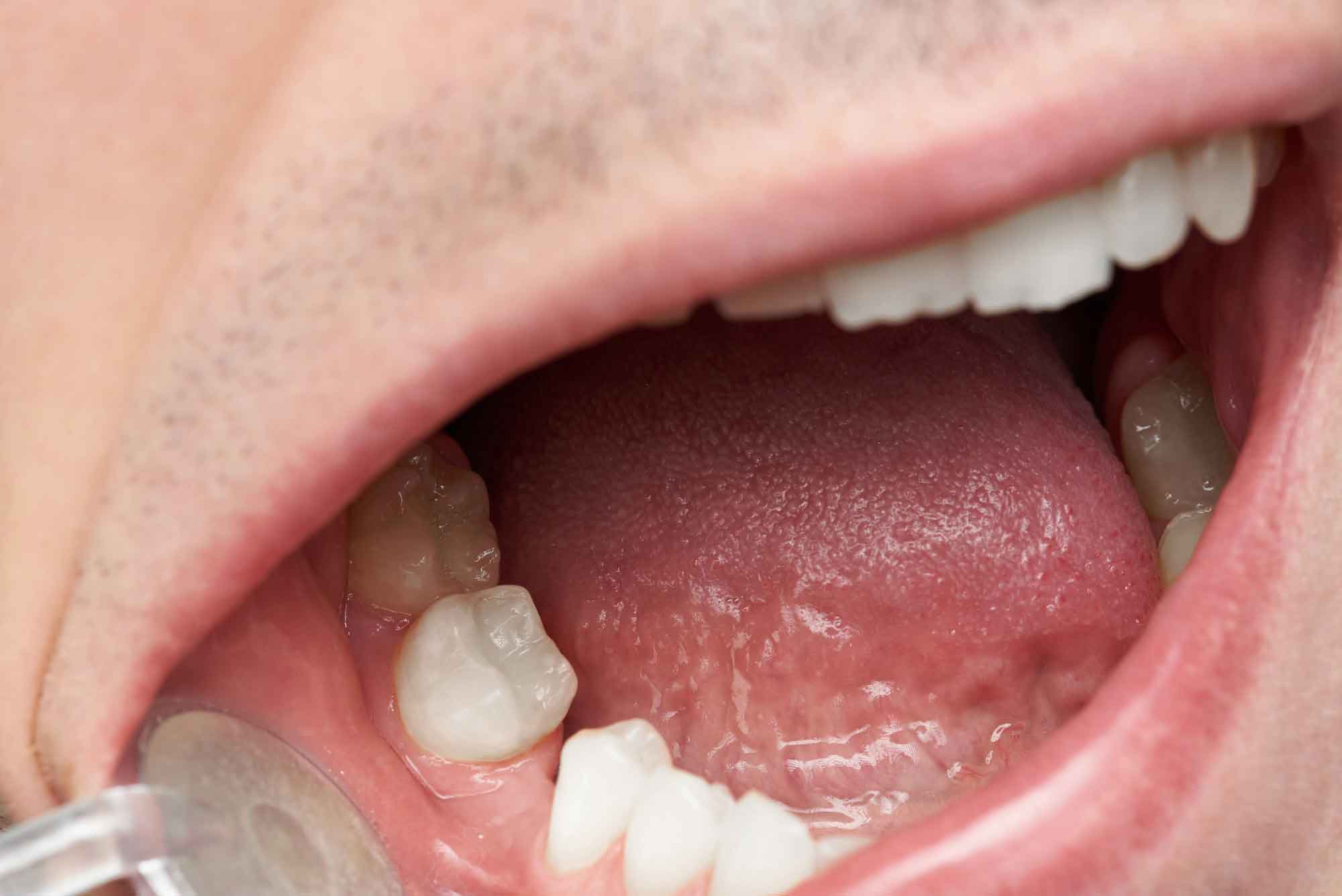 Жить без зубов или протезирование?