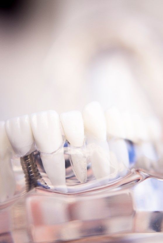 Срок службы зубных имплантов