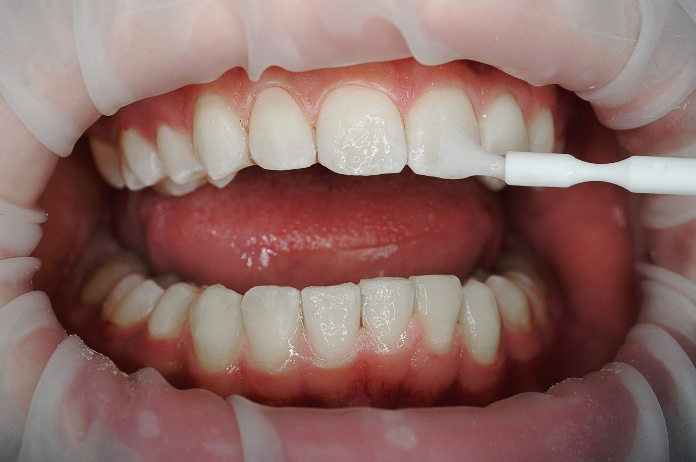 Как правильно укрепить зубы