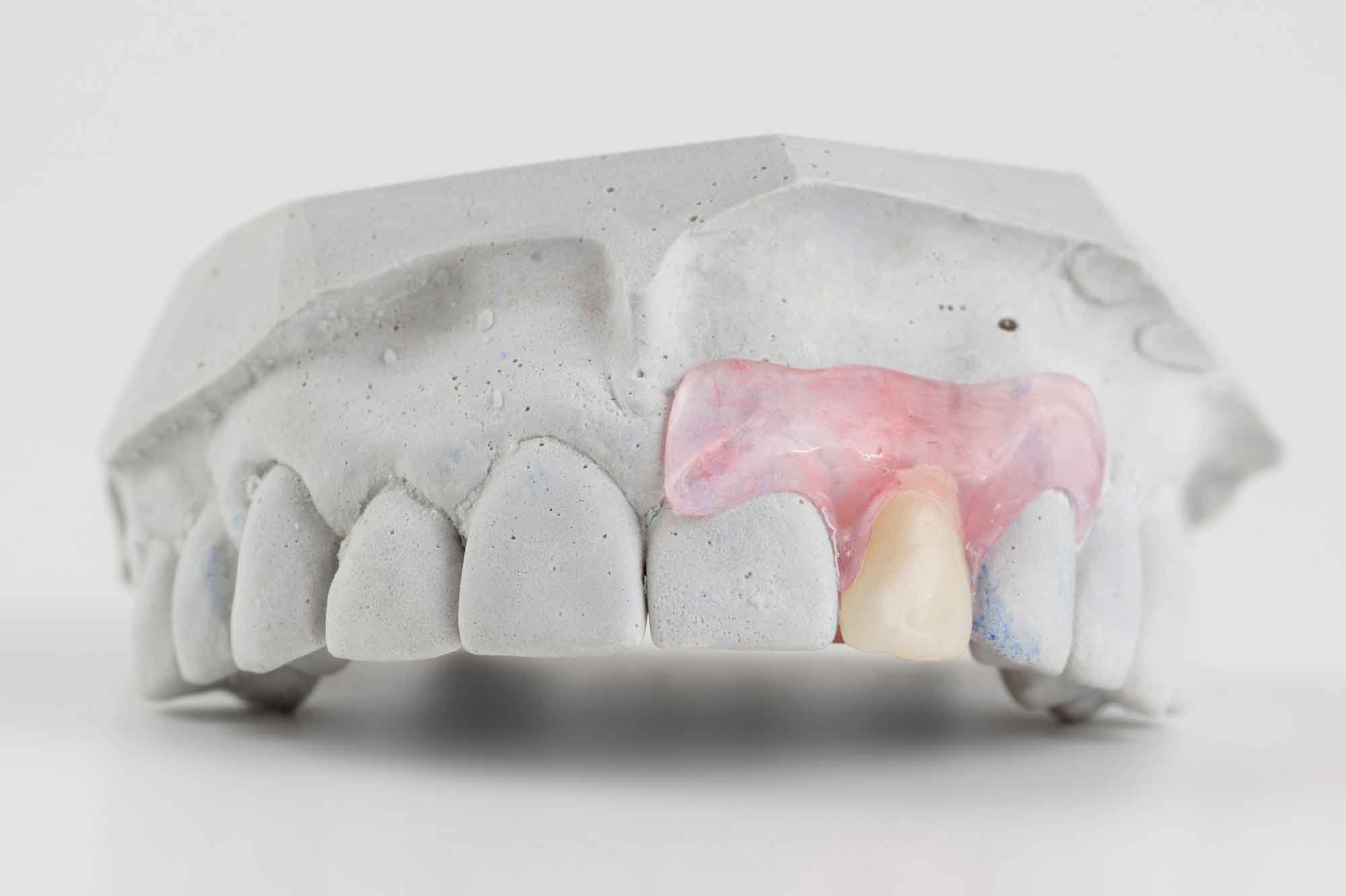 Съемный зуб бабочка. Иммедиат протезы ортопедическая стоматология. Иммедиат протез бабочка 1 зуб. Микропротез нейлоновый «бабочка» иммедиат-протез. Нейлоновый иммедиат протез.