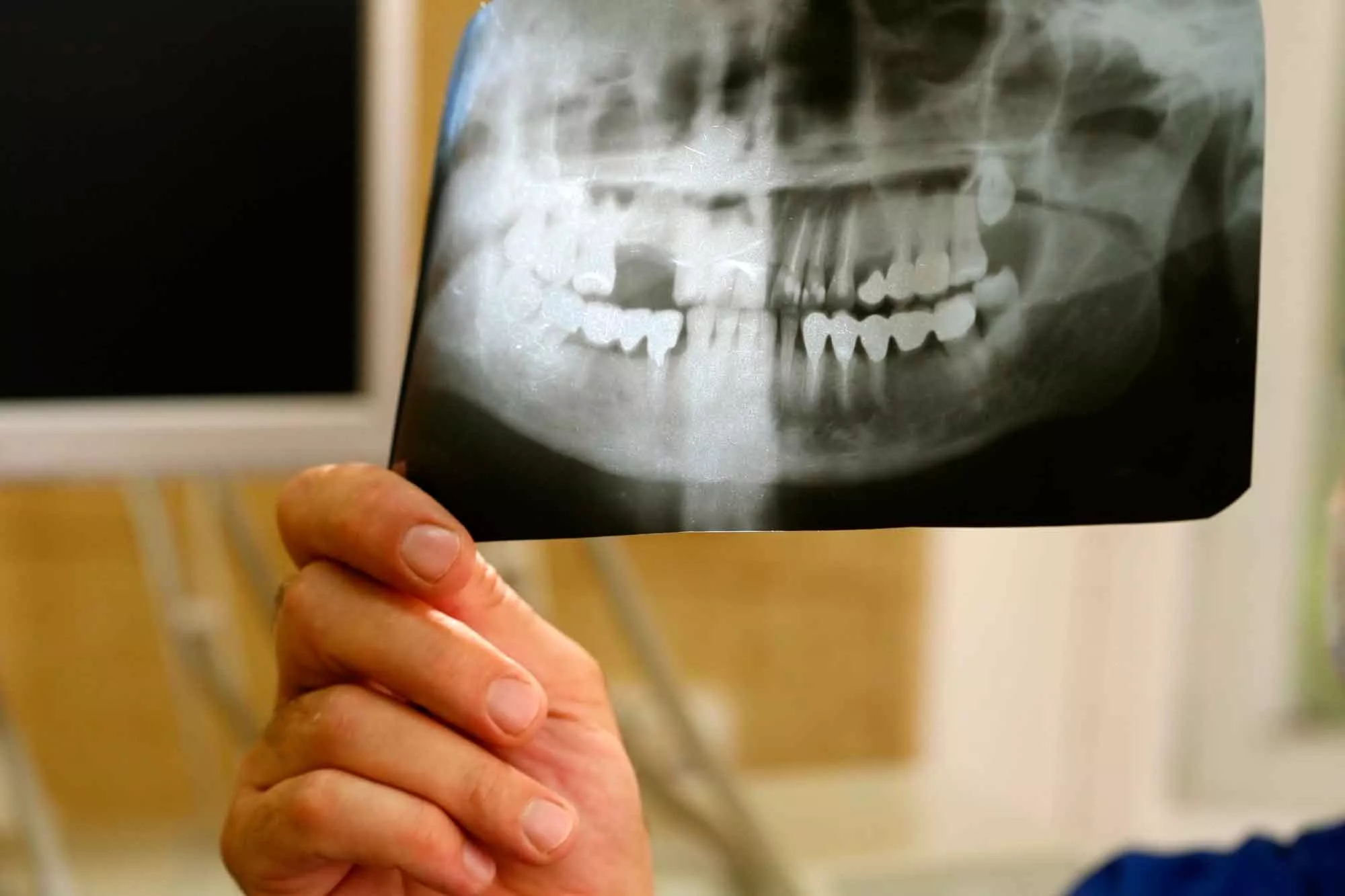 Можно ли вылечить сложный случай или лучше удалить больной зуб? 