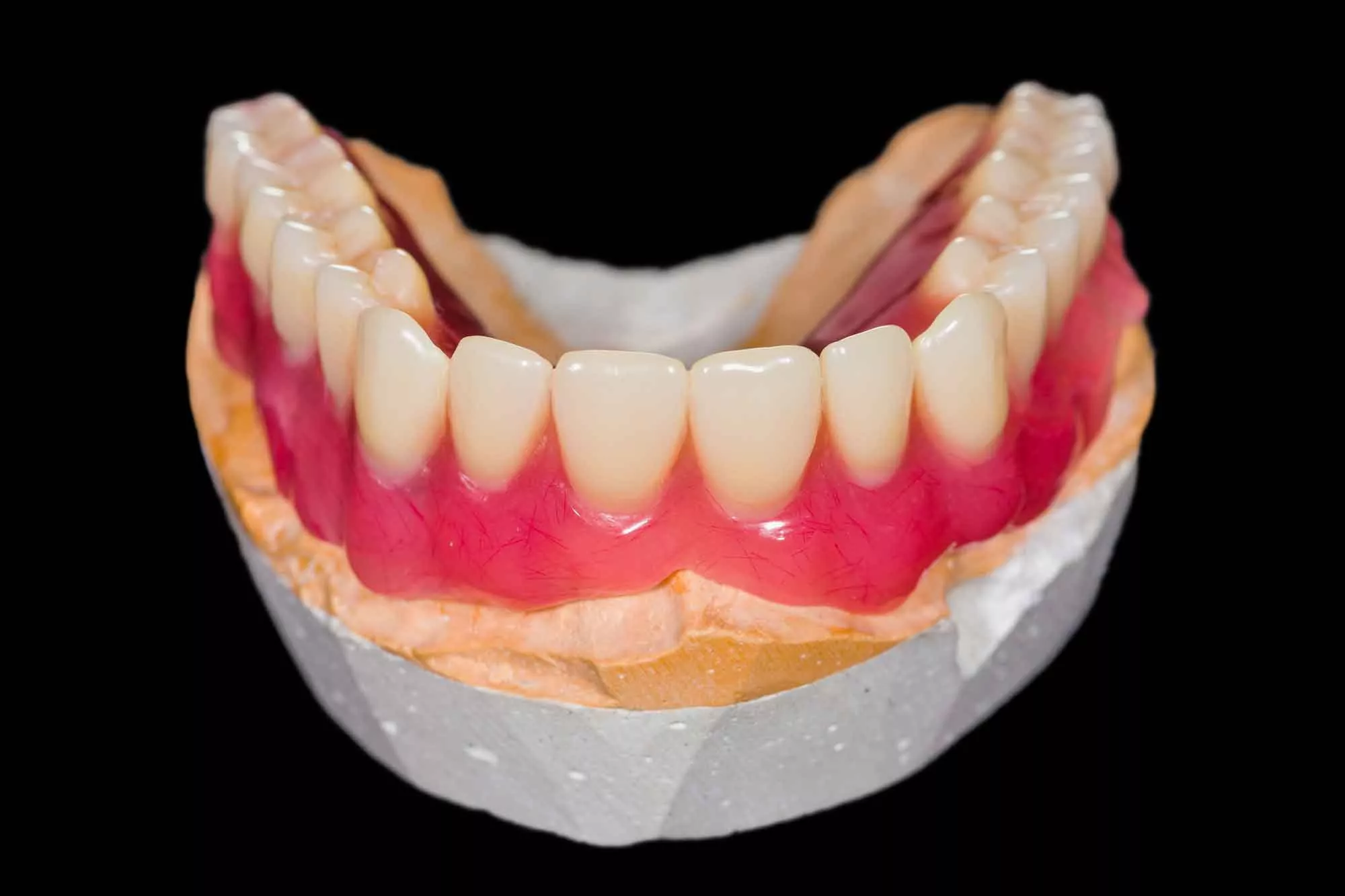 Методы фиксации съемного зубного протеза 1
