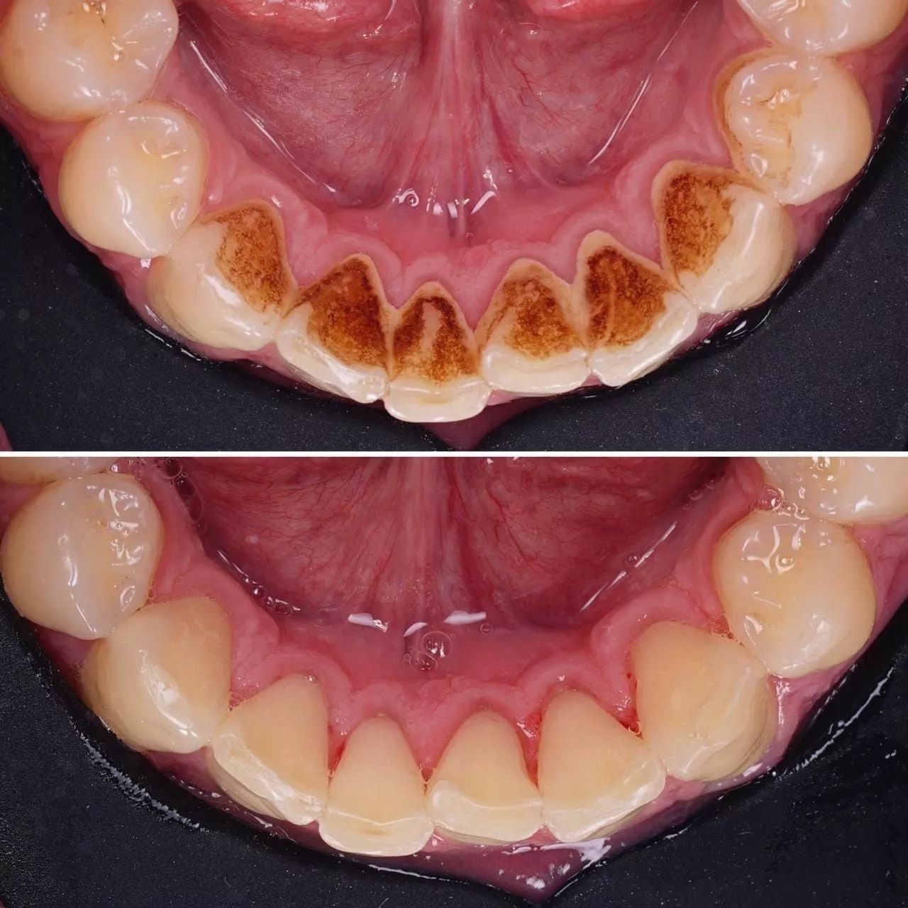 Почему темнеют зубы и как бороться с этой проблемой?