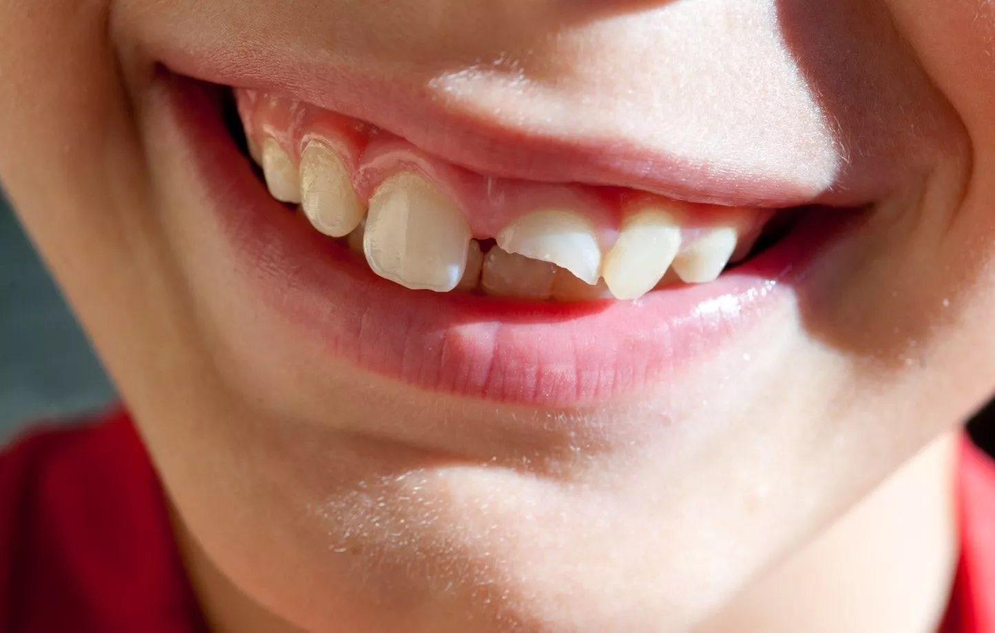 Что такое синдром треснувшего зуба и как его лечить?