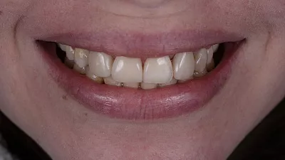 Искусство художественной реставрации зубов.