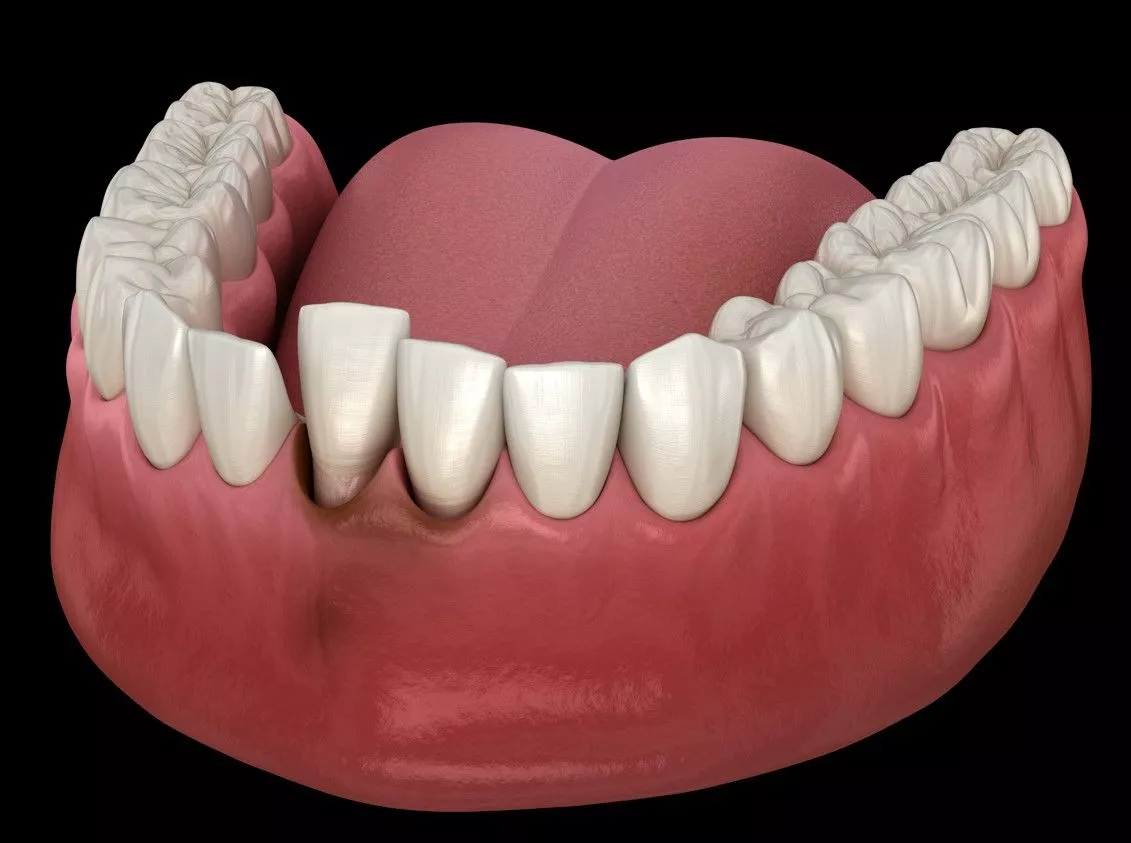 Вывих зуба: основные симптомы и методы лечения. 