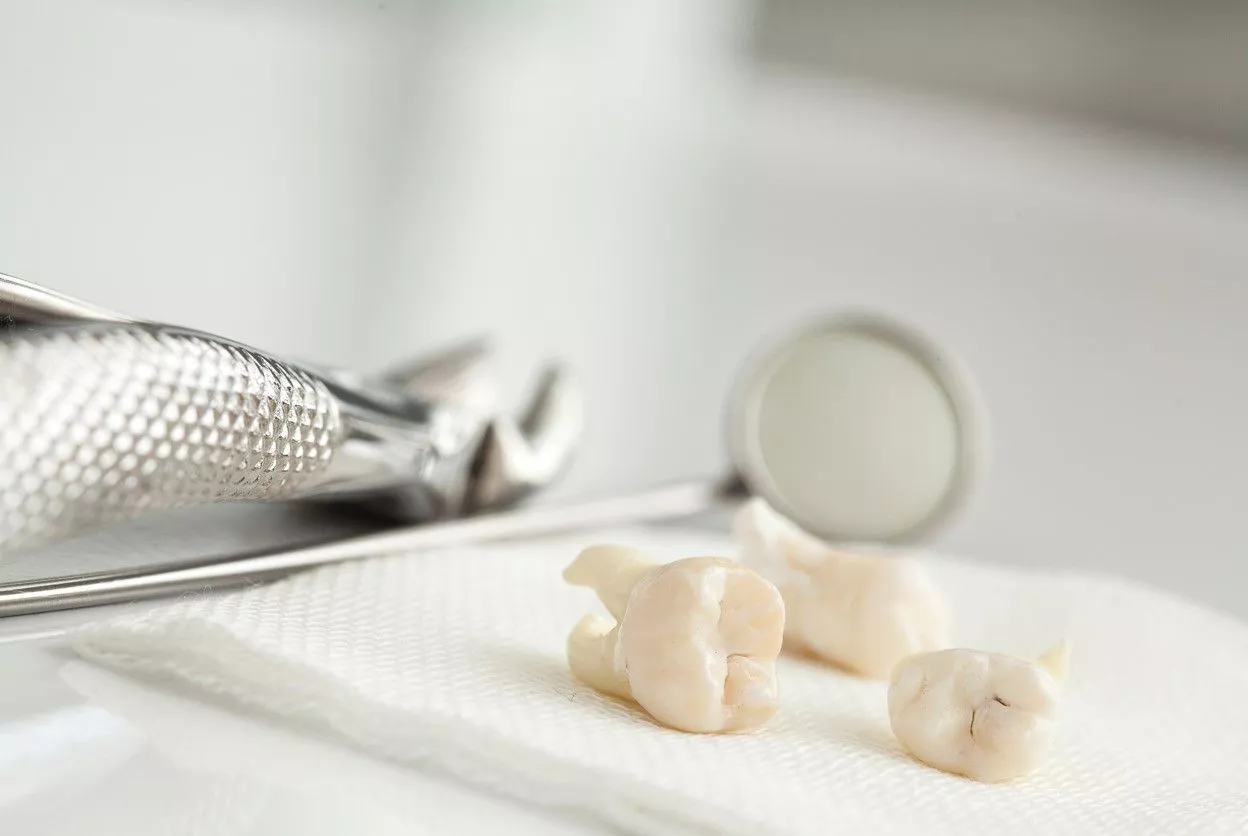 Что такое реплантация зуба: особенности проведения операции