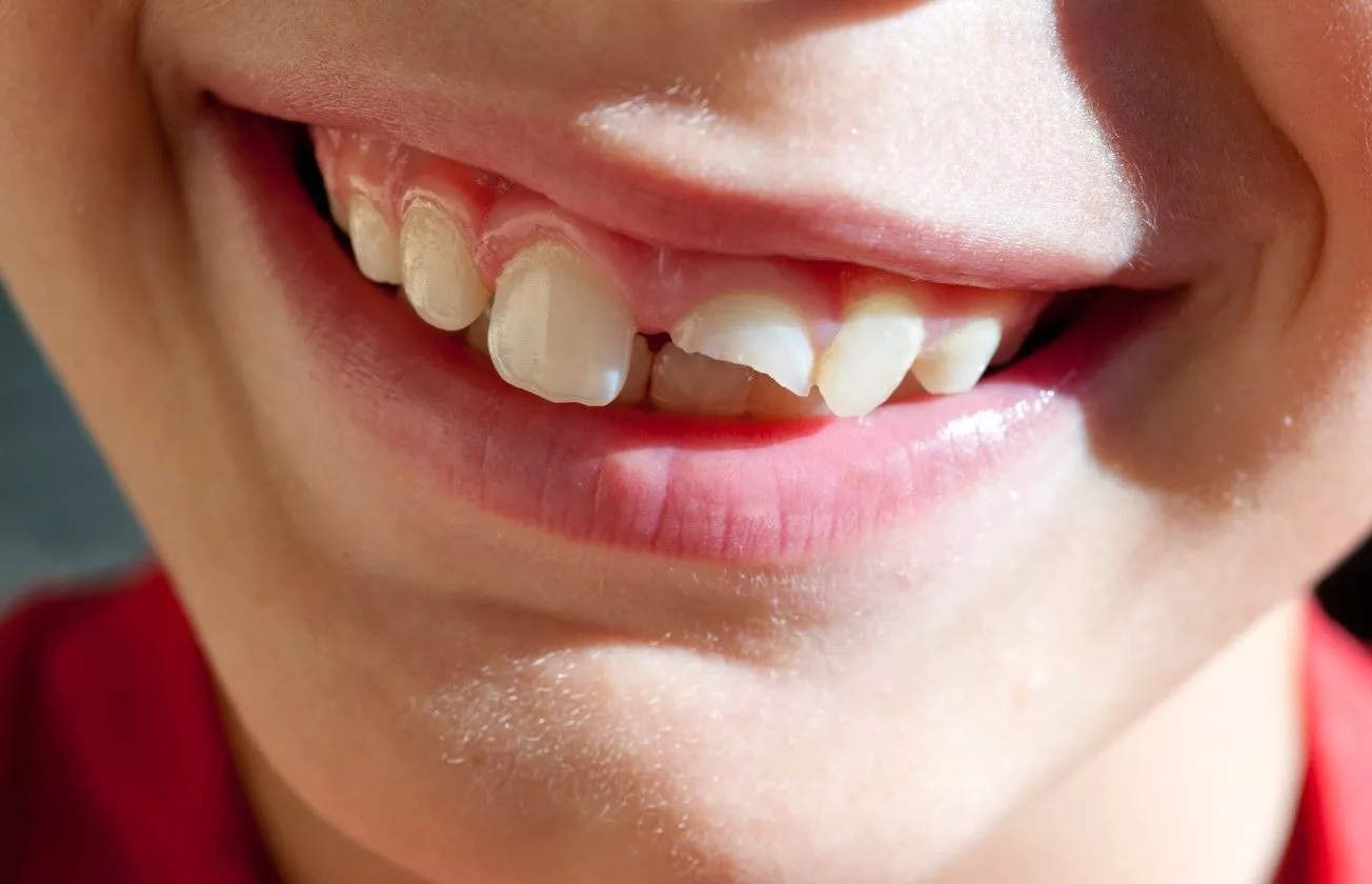 С какого возраста разрешена художественная реставрация передних зубов?