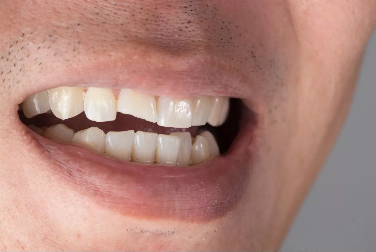 Перелом переднего зуба 