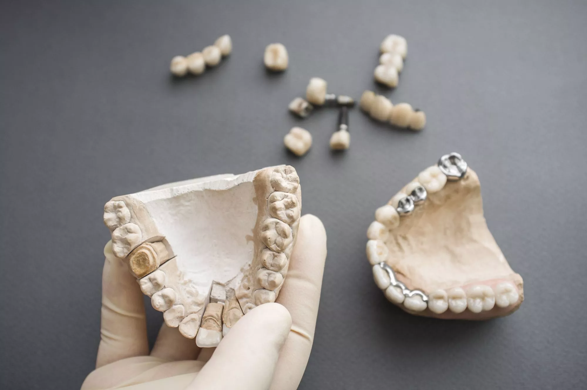 Методы фиксации съемного зубного протеза 3