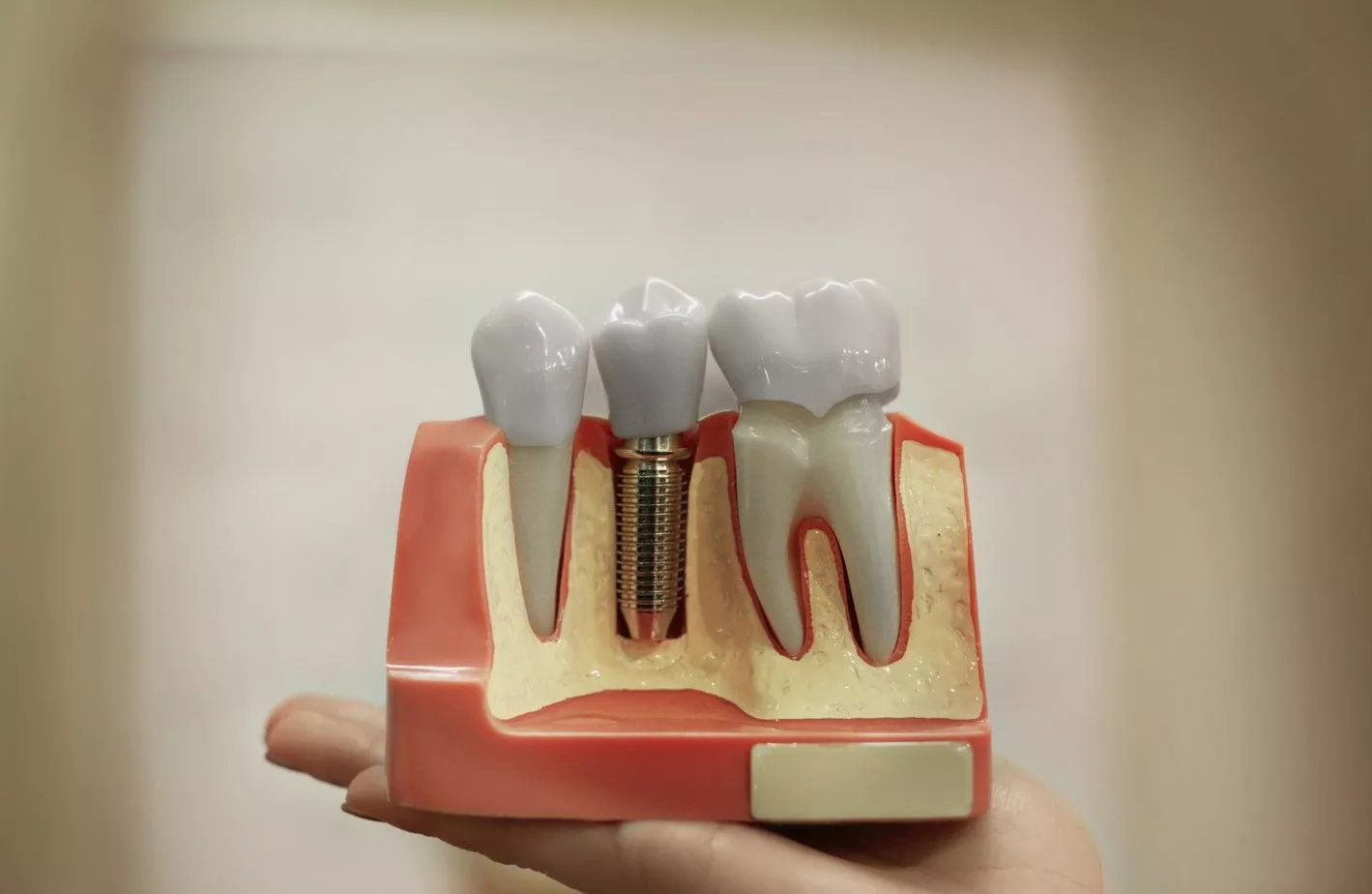 Причины отторжения импланта зуба