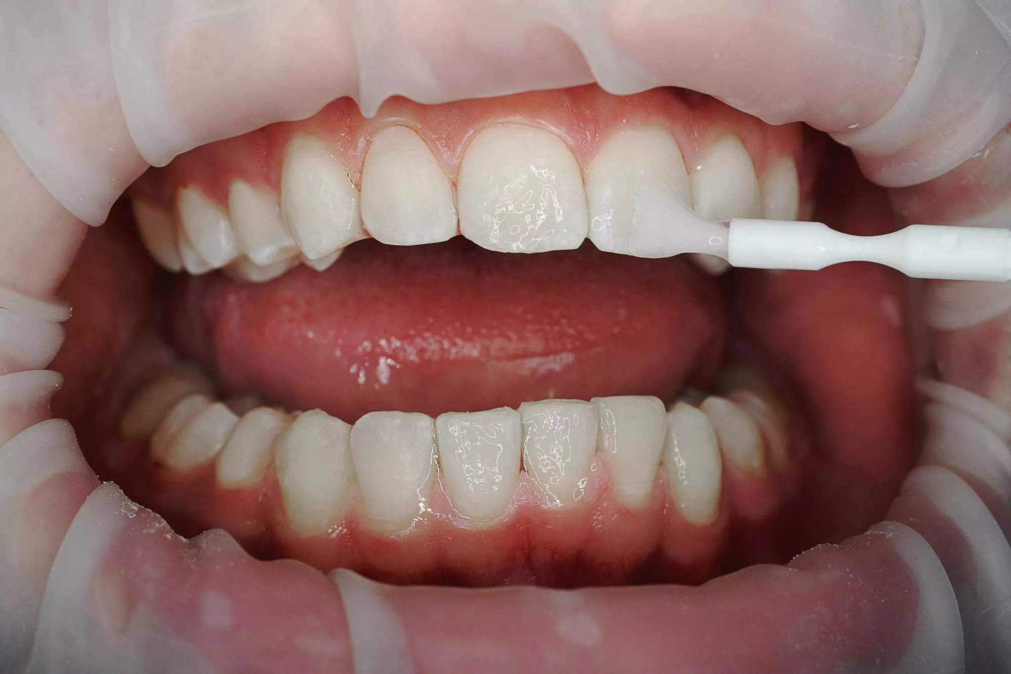 Жить без зубов или протезирование? 0