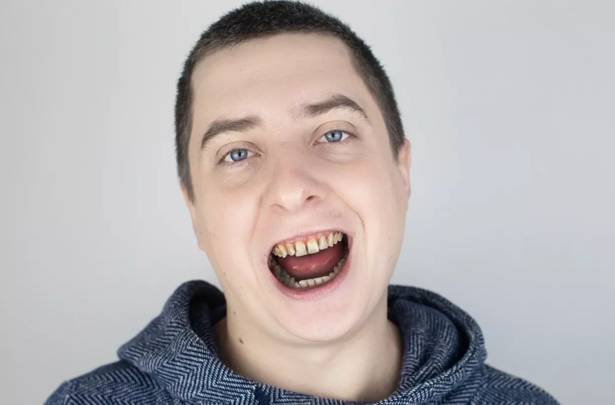 Гнилые зубы: чем опасны и как лечить? | Цифровая стоматология Денталь в Москве | Дзен