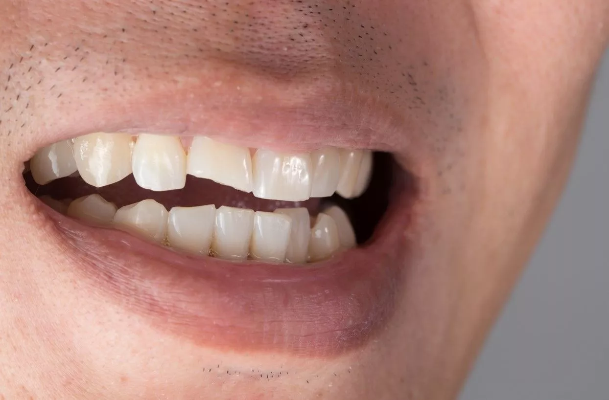 Что делать если откололась часть зуба?