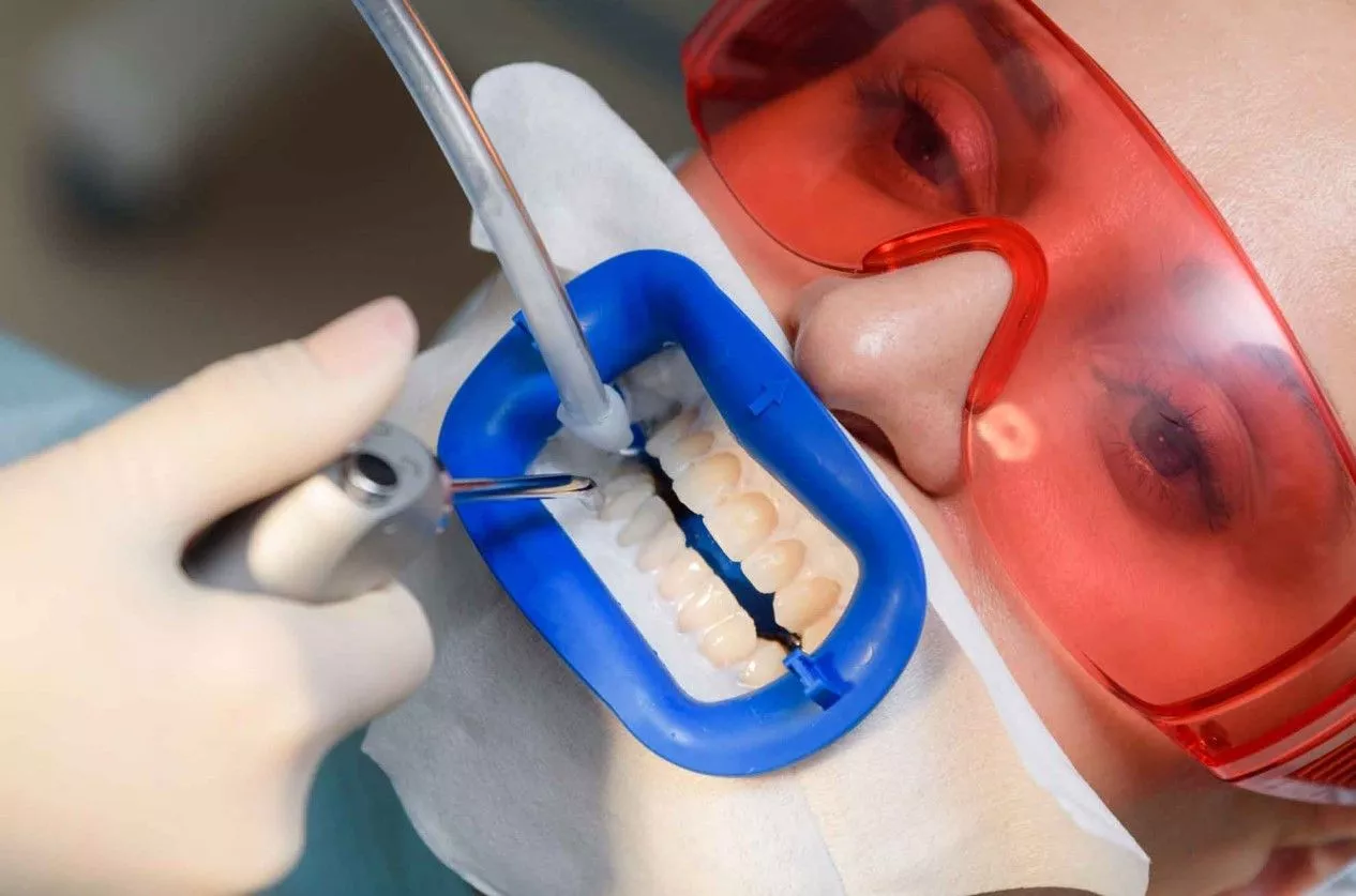 Какой способ отбеливания зубов самый безопасный и эффективный?